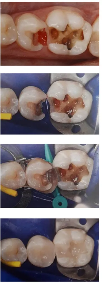 Figure 26: Elimination des anciennes  restaurations et tissus dentaires altérés 