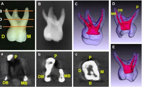 Figure 4 : photographies de la dent (A), radiographies (B) et images 3D des structures de  la dent et de ses canaux radiculaires (C, D, E) d'une deuxième molaire temporaire 