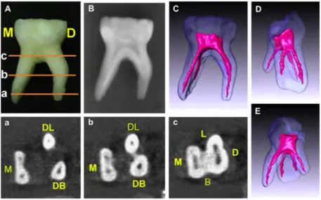 Figure 7 : photographie de la dent (A), radiographie (B) et les images 3D des structures  de la dent et de ses canaux radiculaires (C, D, E) d'une deuxième molaire temporaire 
