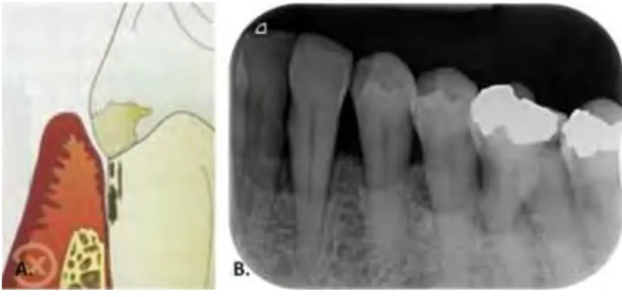 Figure 1. Lésion supra-osseuse. 