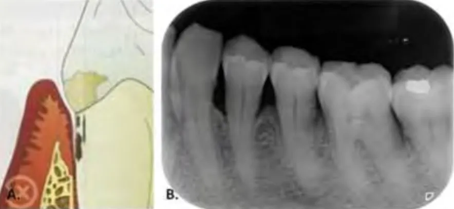Figure 2. Lésion intra-osseuse. 