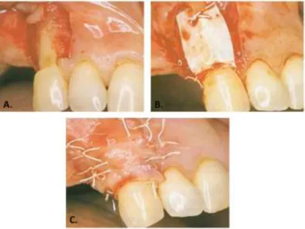 Figure 6. Recouvrement radiculaire par RTG : déroulement de l’intervention.  A. Levée du lambeau