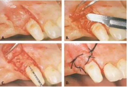 Figure 9. Recouvrement radiculaire par RTG : réalisation des retouches. 