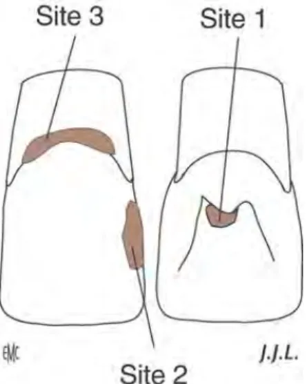 Figure 3 : Schéma des 3 sites au niveau de dents antérieures [2] 