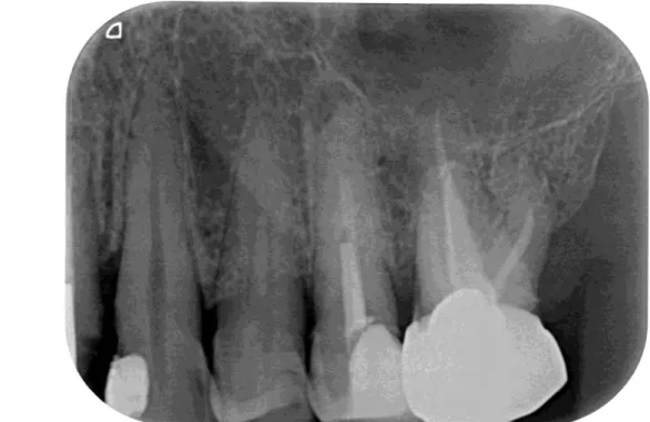 Figure 11 : Radiographie rétro-alvéolaire de la 24, 1 an après l'intervention initiale, lors de la première visite 