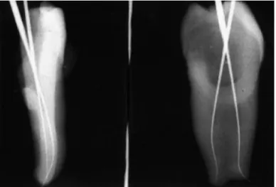 Figure	   1	  : 	   Détermination	   de	   la	   longueur	   de	   travail	   à	   l’aide	   d’un	   cliché	   vestibulo-­‐lingual	   (à	   gauche)	   et	   d’un	   cliché	  mesio-­‐distal	  (à	  droite)	  qui	  permet	  de	  bien	  différencier	  les	  deux	  canaux	  sur	  cette	  prémolaire	  maxillaire.	   Kytridou,	  1999,	  (59)	  