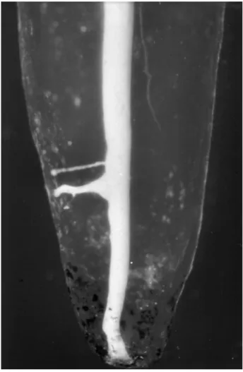 Figure	  5	  :	  Photographie	  de	  l’obturation	  de	  plusieurs	  canaux	  latéraux,	  Al-­‐Dewani,	  2000,	   (1) 	   	  