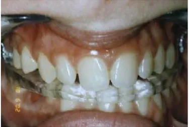 Figure 6-La gouttière de reconditionnement musculaire 