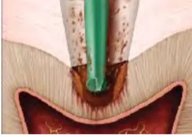 Figure 2: Une fraise Smartburs de chez SS White. (16) 