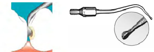Figure 11: Un insert Sonicflex de chez KaVo micro n° 30 (88) 