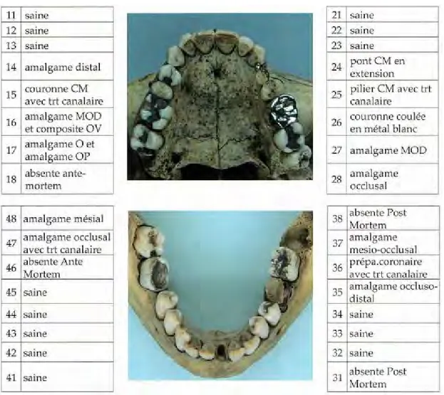 Figure 11 : Vues antérieures et latérales droite et gauche des maxillaires (12) 