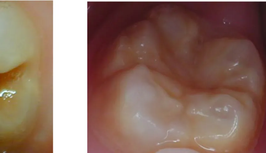 Illustration	   8	  :	   photographie	   d’une	   patiente	   dont	   l’ensemble	   des	   dents	   présente	   une	   coloration	  blanc-­‐opaque	  diffuse	  caractéristique	  d’une	  fluorose.	  