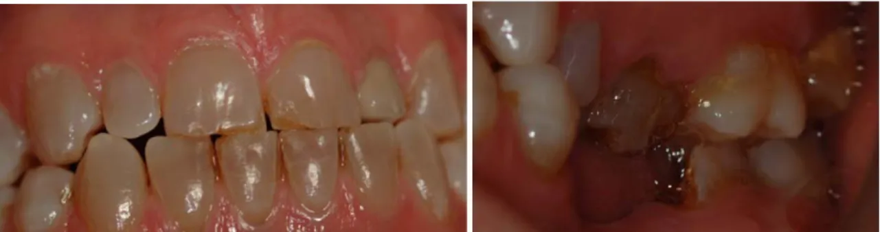 Illustration	  20	  :	  photographie	  des	  dents	  en	  occlusion	  	   	  