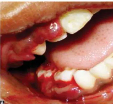 Fig. 3 : Manifestations buccales du scorbut  
