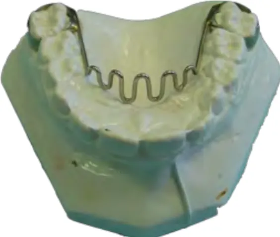 Figure 6 : GRILLE ANTI-LANGUE [38]  E.  La perle de Tucat 