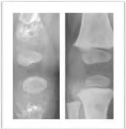 Figure 2 : Radiographie du genou d’un nourrisson atteint d’hypophosphatasie (à gauche)  et d’un enfant normal de 9 mois (à droite)