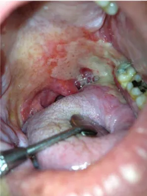 Figure 6 : Mucite radio-induite au niveau de l'amygdale (Photo consultation pluridisciplinaire muqueuse buccale IUCT) 