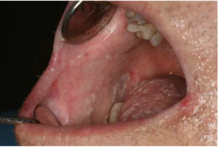 Figure 7 : Candidose pseudo-membraneuse (Photo consultation pluridisciplinaire muqueuse buccale IUCT) 