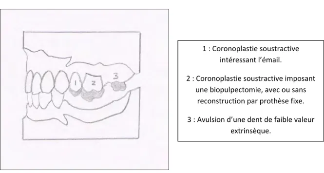 Figure 26: Schéma permettant d’expliquer au patient les différents aménagements possibles, d’après 