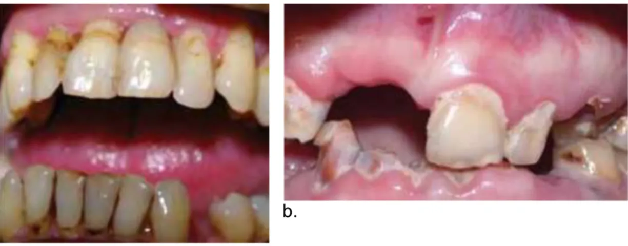 Figure 9: a) Détérioration dentaire chez un jeune patient atteint d’hépatite C. b) Détérioration  dentaire chez un patient âgé atteint de l’hépatite C