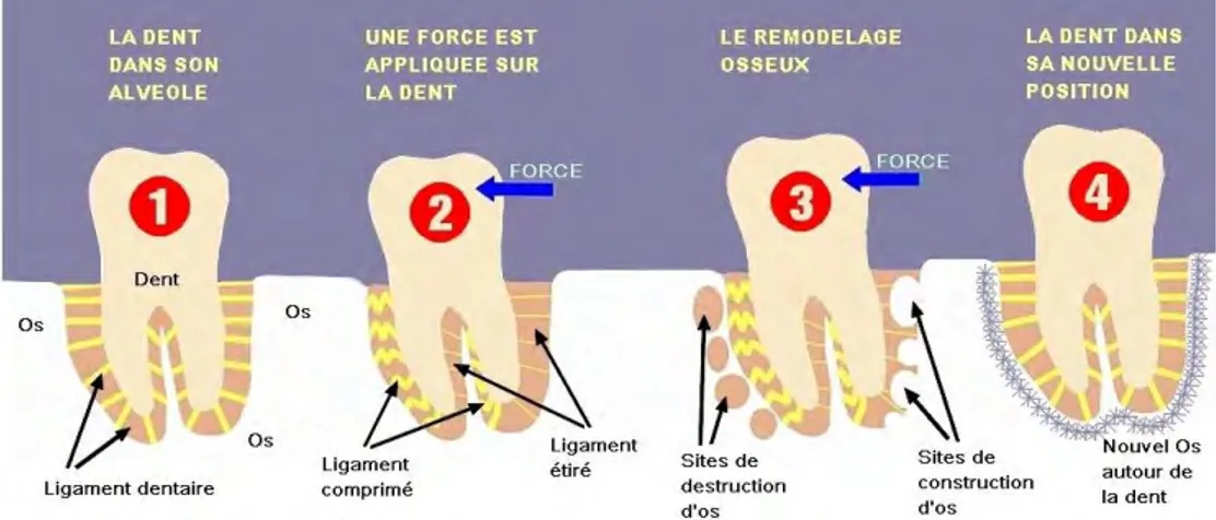 Figure 6 : Schéma explicatif du mouvement dentaire provoqué (Source :  https://www.cabinet-