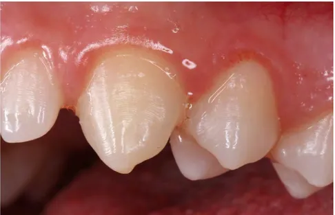 Figure 9: Périkymaties particulièrement marquées sur des dents  jeunes (Image empruntée au Dr OSTROWSKI) 