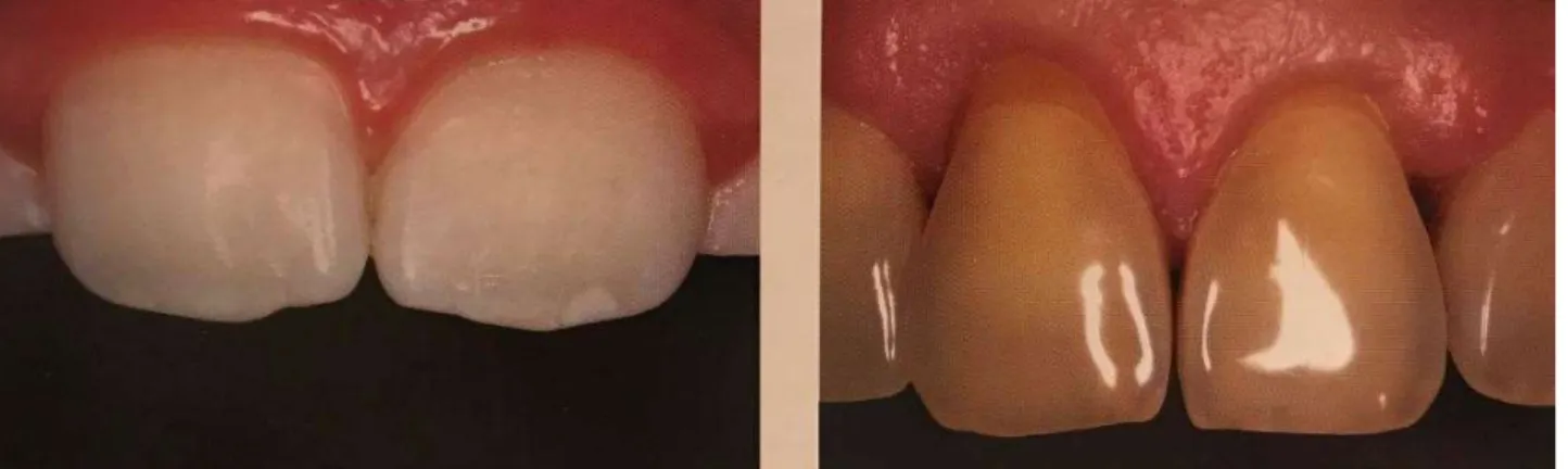 Figure 13: La translucidité augmente avec le vieillissement de gauche à droite  32