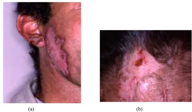 Figure   7  : Photographie d'ulcérations palatines chez un patient souffrant de Lupus érythémateux disséminé (20).