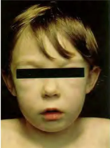Figure    8  :  Photographie   d'un   enfant   présentant   des   œdèmes   au   niveau   palpébral   dûs   à   une glomérulonéphrite (22).