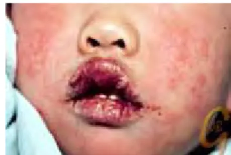 Figure    10    :  Photographie de lèvres rouges et fissurées chez un enfant atteint de la maladie de Kawasaki (30).