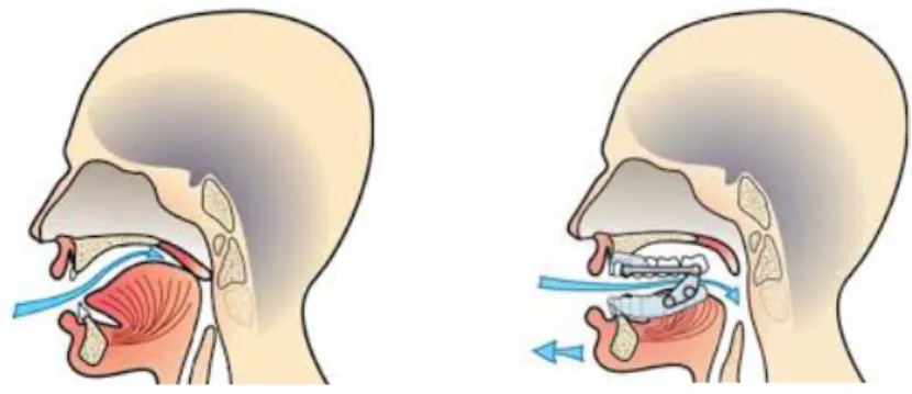 Figure	 7	 :	 Mécanisme	 d’une	 orthèse	 d’avancée	 mandibulaire.	 (30)	 A	 droite	 :	 espace	 postérieur	 pharyngien	réduit	chez	un	patient	apnéique.	A	gauche	:	dégagement	des	voies	aériennes	supérieures	 par	avancement	de	la	mandibule.	 				 Il	faut	tout	de	même	noter	que	les	modifications	de	configuration	des	voies	aériennes	par	 l’utilisation	d’OAM	restent	variables	selon	les	personnes,	et	que	les	réponses	thérapeutiques	 sont	donc	elles	aussi	dépendantes	des	individus	.(31)	 	 2.2.2.	Indications	 	 	 2.2.2.1.	Recommandations	actuelles		 	