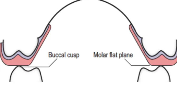 Figure	 41	 :	 Coupe	 frontale	 d’une	 gouttière	 occlusale	 au	 maxillaire	 montrant	 la	 surface	 plane	 en	 postérieur,	 l’espace	 respecté	 entre	 les	 molaires	 et	 les	 contacts	 présents	 au	 niveau	 des	 cuspides	 d’appuis	(73) 	