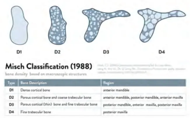 Figure 1 : Classification de la densité osseuse de Misch 106
