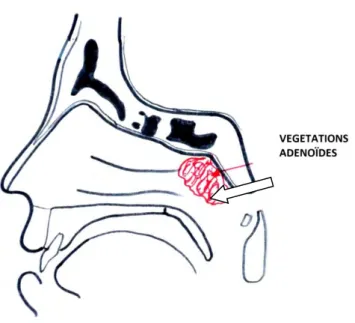 Figure 7 : Localisation des végétations adénoïdes * 