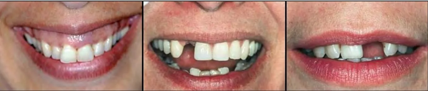 Figure 2 : Ligne du sourire haute (à gauche) - moyenne (au milieu) - basse (à droite)