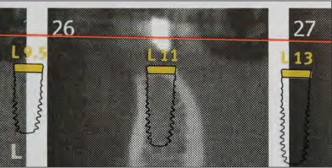 Figure 5 : Planche radiographique avec calque implantaire (Xive-S) 