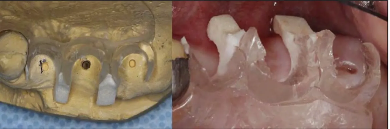 Figure 7 : Guide chirurgical sur le modèle en plâtre et en bouche 