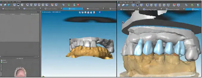 Figure 12 : Conception de projet prothétique sur Dental Wings© 