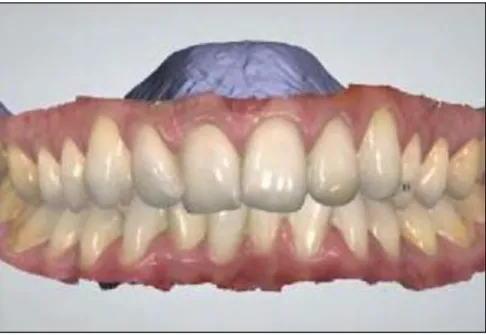 Figure 13 : Empreinte optique avec système 3Shape TRIOS® 