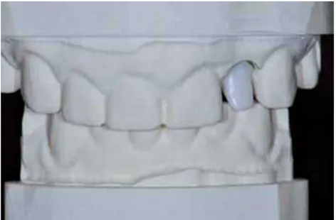 Figure 24 : Photographie du pilier implantaire personnalisé sur le modèle en polyuréthane