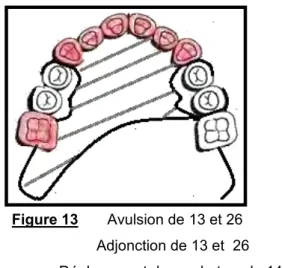 Figure 13       Avulsion de 13 et 26                        Adjonction de 13 et  26                       Déplacement du crochet sur la 14 