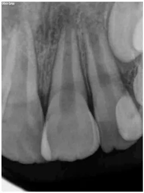 Figure 6: Rétroalvéolaire d’une 21 et 22 immatures.  