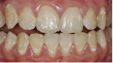 Fig 9. Caries débutantes suites à un traitement orthodontique multi-bagues, Denis et al, 2013