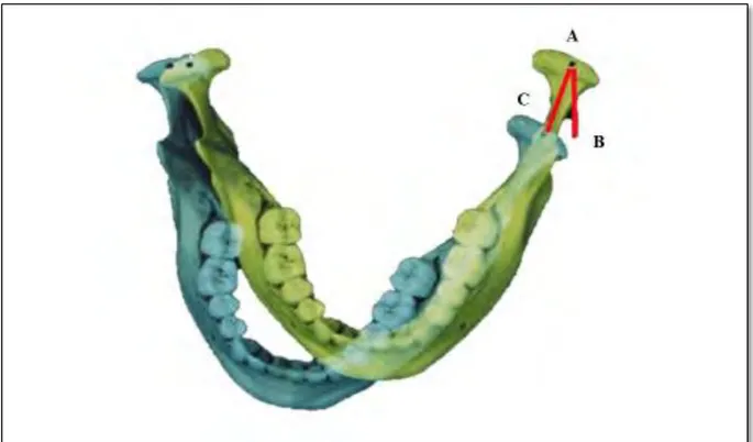 Figure 5 : du fait de la distance constante inter condylienne dans le mouvement de  latéralité le condyle travaillant effectue un mouvement en dehors, illustré par la flèche