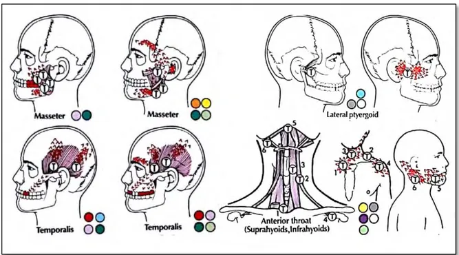 Figure 11 : représentation des zones gâchettes des troubles de l’articulation temporo- temporo-mandibulaire    de  la  région  cervicale  antérieure  et  des  régions  masséteriennes,  temporales, latero-ptérygoïdiennes