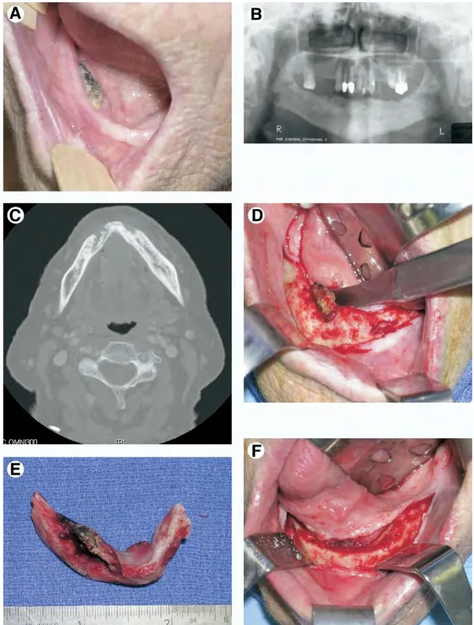 Figure 9.a: Résection marginale : Patient traité par acide alendronique (Fosamax®), présentant un os  exposé et nécrosé secteur 4, suite à l’avulsion multiple de dents après l’initiation de l’acide 
