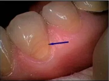 Figure	
  3.	
  (122)	
  Abrasion	
  cervicale	
  due	
  au	
  brossage,	
  	
  «	
  les	
  traces	
  des	
  poils	
  de	
  brosse	
  à	
   dents	
  sont	
  visibles…	
  »	
  