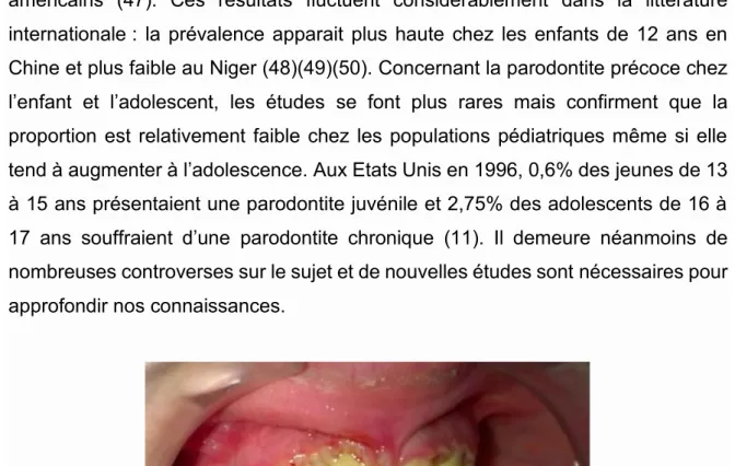 Figure 4 : Parodontite ulcéro-nécrotique chez une adolescente (Dr Marty, CHU Toulouse) 