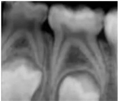 Figure	
  2:	
  Ligament	
  alvéolo	
  dentaire	
  en	
  denture	
  temporaire	
  (4)	
  