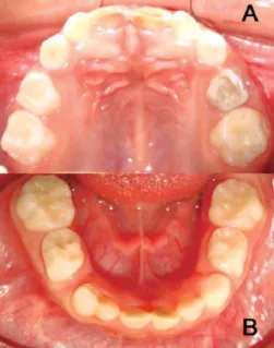 Figure 6 : Vue endobuccale 2 d’un patient atteint de rachitisme (138) 